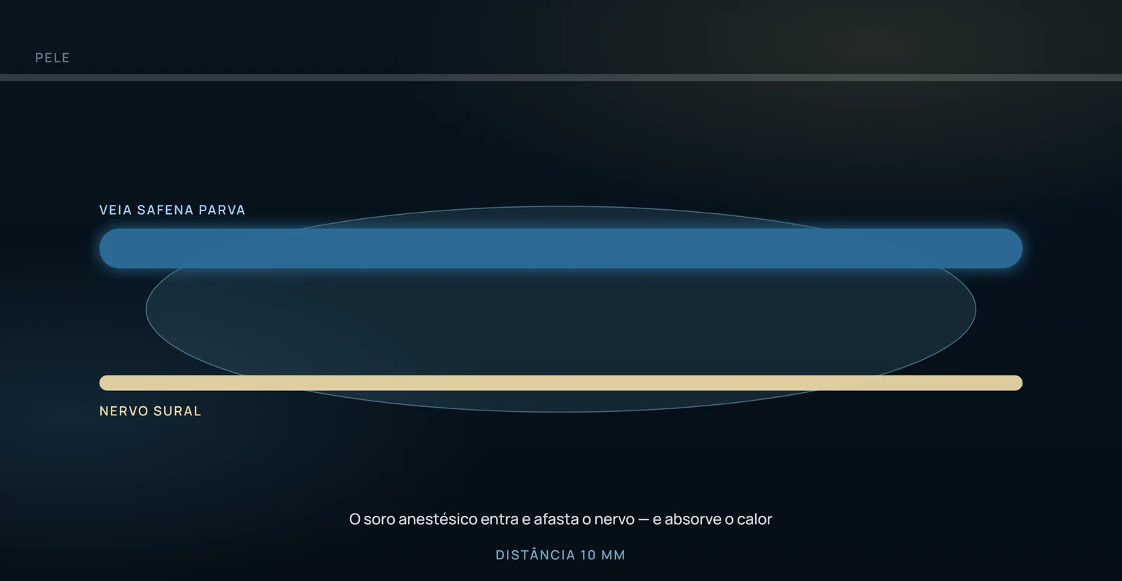 O desenho mostra o que a injeção faz no plano: o líquido circunda a veia, afasta dela o que estava colado e absorve o calor do disparo.