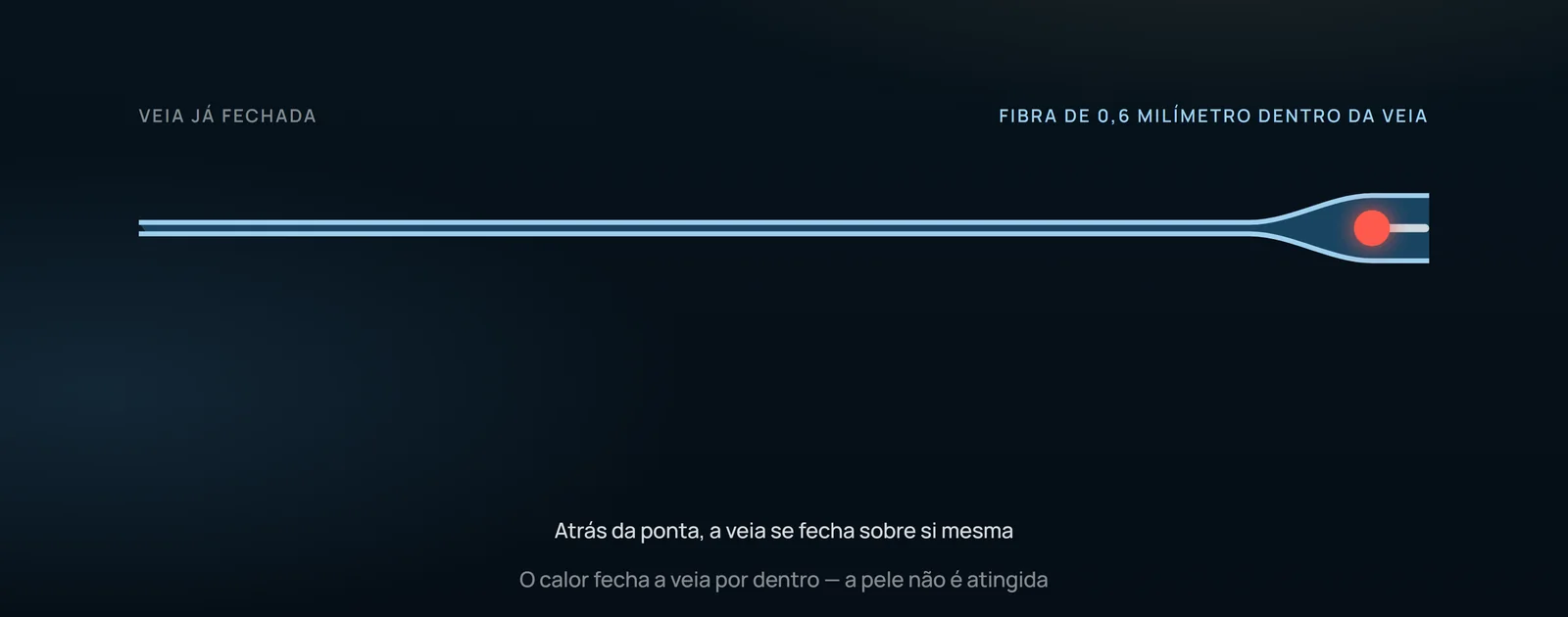 O desenho mostra a fibra avançando por dentro da veia e a parede se fechando atrás da ponta quente: o calor age de dentro, sem atingir a pele. O que a imagem não revela é até que camada da parede esse dano chegou.