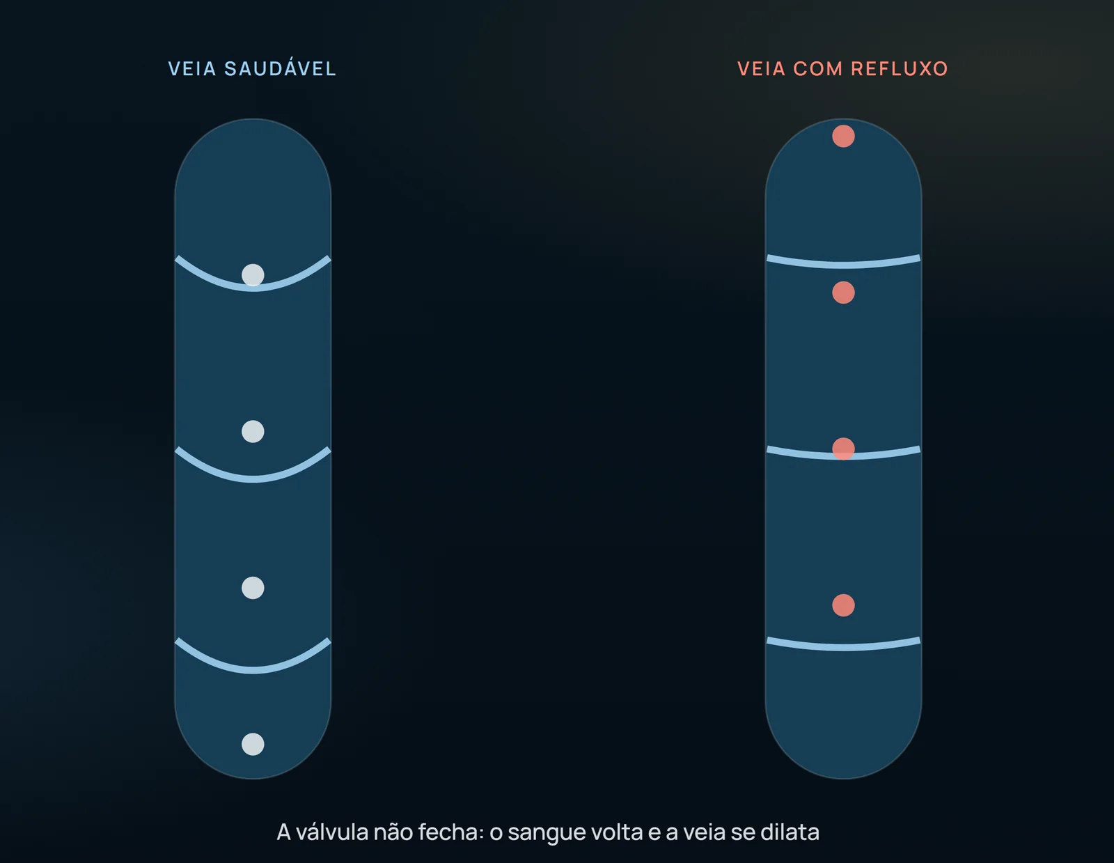 La válvula que no cierra deja que la sangre baje y la vena se dilate: es el mecanismo que mantiene la presión alta en la pierna ulcerada. Ningún comprimido devuelve la válvula a su sitio — por eso el venoactivo entra como adyuvante.